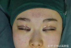 双眼皮埋线视频全过程,从术前准备到术后恢复